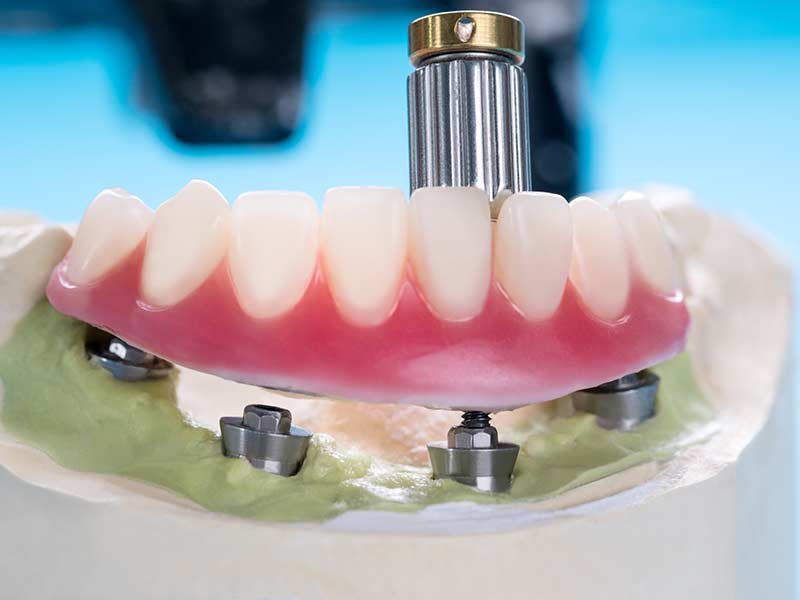 implante-dentario-barato-preço-baixo-bh
