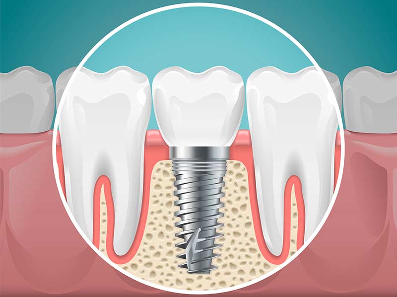 implantes-odontologicos-em-bh-melhor-preço