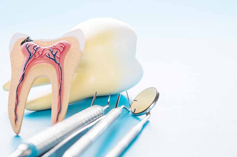 tratamento-de-canal-aparelho-dentario-para-dentes-perfeitos-em-bh-preço-baixo
